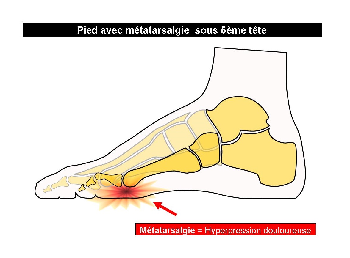 Diagramme De Douleur Au Pied — free download